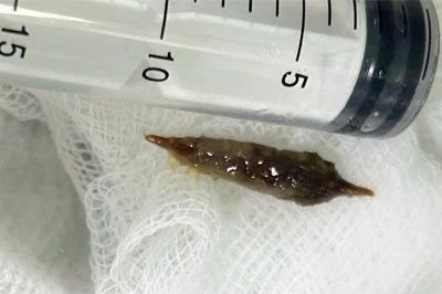 Cô gái suýt thủng dạ dày vì vô tình nuốt hạt táo đỏ, bác sĩ đưa ra khuyến cáo