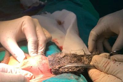 Đau bụng, nôn nhiều, bé trai 46 tháng tuổi phát hiện búi tóc khổng lồ trong dạ dày