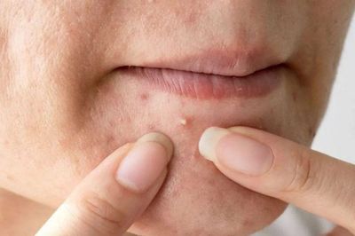 Mẹo chăm sóc da sau khi nặn mụn đúng cách: 5 bước giúp da nhanh lành, hạn chế thâm sẹo