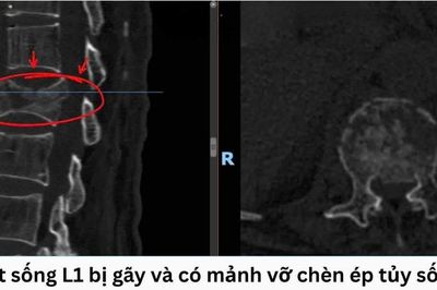 Ngã từ mái nhà, người đàn ông suýt liệt vì gãy đốt sống thắt lưng