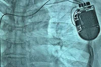 Cứu cụ ông ngừng tuần hoàn do 'cơn bão điện học', cấy ICD ngăn đột tử