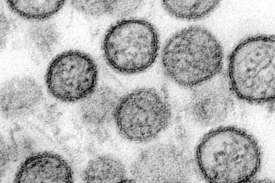Hantavirus trở lại Nam Mỹ: Chile báo động khi gần 40% ca mắc tử vong