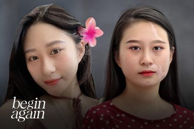 Cô gái bị hủy mặt vì bạch biến thay đổi sau 6 năm điều trị