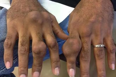 Bác sĩ cảnh báo về nguy cơ tàn phế khi coi nhẹ bệnh gout