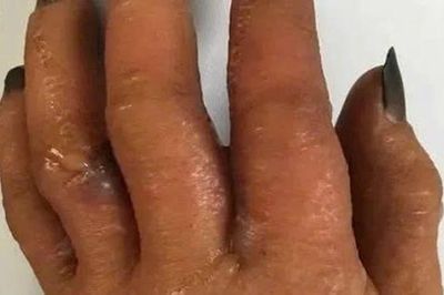 Nguy cơ dị ứng từ thuốc nhuộm tóc, lời khuyên từ bác sĩ da liễu