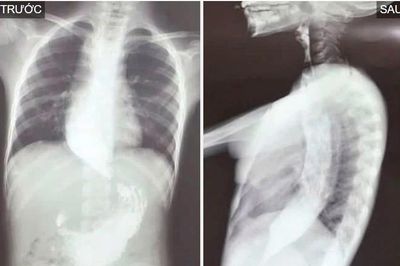 Nuốt nghẹn suốt 3 năm, bé trai 10 tuổi mắc co thắt tâm vị hiếm gặp