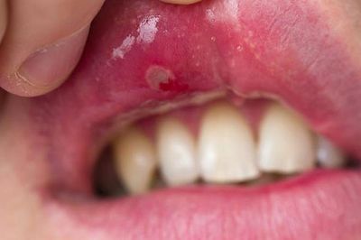 5 lưu ý chăm sóc răng miệng cho người bệnh Lupus ban đỏ