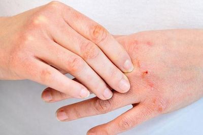 6 thói quen giúp kiểm soát viêm da cơ địa, giảm nguy cơ tái phát