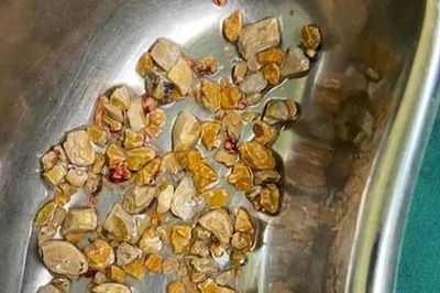 'Thủ phạm' âm thầm nuôi dưỡng sỏi thận
