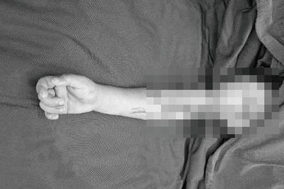 Nối liền cánh tay cho bé 4 tuổi gặp tai nạn với áo chống nắng