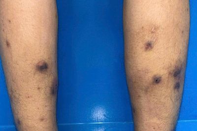 Điều trị thành công ca bệnh viêm mạch máu cực hiếm tại Bệnh viện Da liễu TƯ