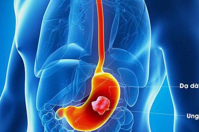 Người đàn ông 62 tuổi mắc ung thư dạ dày thừa nhận suốt 20 năm chủ quan, bỏ qua dấu hiệu này