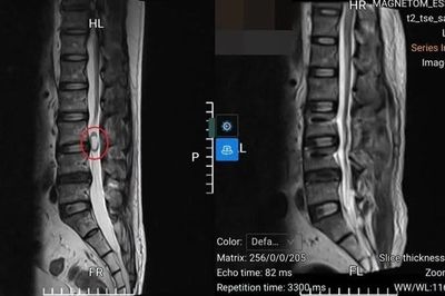Đau lưng kéo dài, người đàn ông 47 tuổi phát hiện u tủy sống