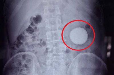 Đau bụng 20 năm trời, người đàn ông sốc khi bác sĩ gắp ra thứ 'đáng sợ' trong bụng