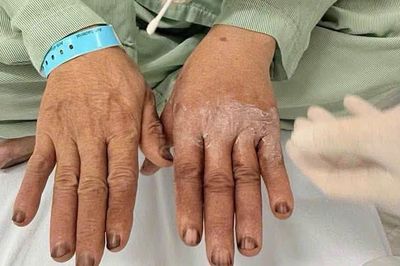 Tự nhuộm tóc tại nhà, người đàn ông bất ngờ phải nhập viện vì lý do không ai ngờ đến