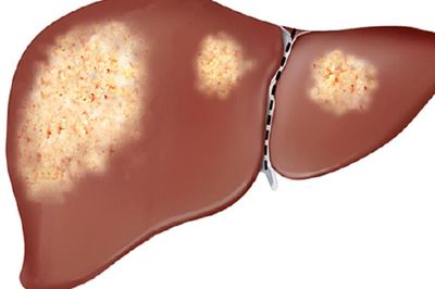Gan nhiễm mỡ: Đừng kỳ vọng chỉ uống thuốc bổ gan là khỏi bệnh