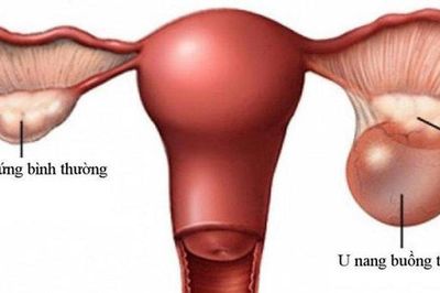 U nang buồng trứng ác tính có chữa được không?