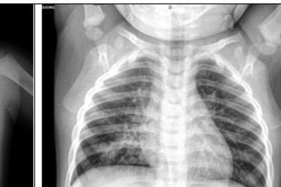Bé trai 3 tuổi ho kéo dài hơn một tháng do dị vật trong phế quản