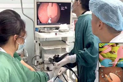 Cắn gãy thìa nhựa khi ăn sữa chua, bé 20 tháng tuổi phải nhập viện cấp cứu