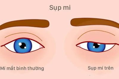 Bệnh lý sụp mi và những điều cần biết