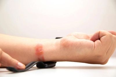 Thủ phạm khiến cổ tay ngứa điên đảo khi đeo đồng hồ dây silicone?