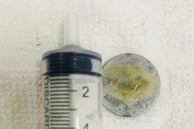 Bé 5 tuổi thoát nguy hiểm nhờ lấy thành công viên pin cúc áo khỏi thực quản