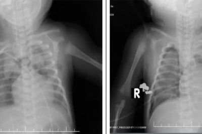 Cứu sống trẻ sơ sinh 1 ngày tuổi suy hô hấp nguy kịch do thiếu surfactant