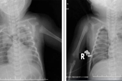 Cứu sống trẻ sơ sinh 1 ngày tuổi suy hô hấp nguy kịch do thiếu surfactant