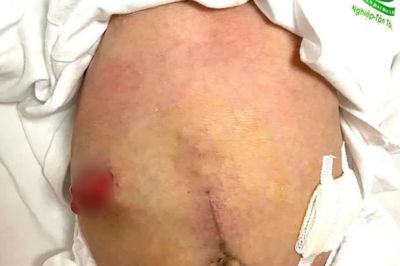 Cứu sống trẻ sơ sinh viêm phúc mạc toàn thể do thủng đại tràng