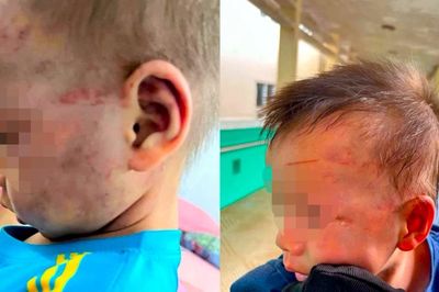 Khởi tố cha dượng đánh bé 3 tuổi bầm tím mặt mũi