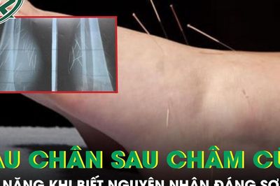 Đau chân dữ dội sau châm cứu, người phụ nữ sốc nặng khi biết nguyên nhân