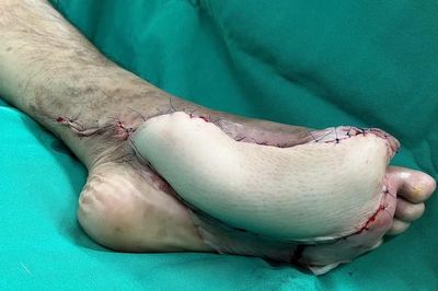 Chủ quan với vết xước nhỏ, nhiều người đối mặt nguy cơ tàn phế