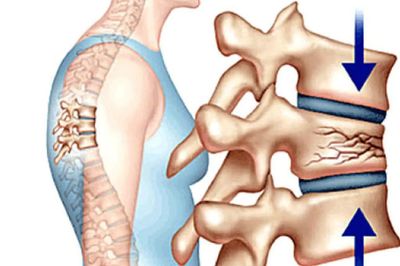 Biến chứng xẹp gãy đốt sống vì chủ quan với loãng xương
