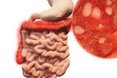 Viêm ruột có nguy hiểm không?