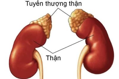 Lạm dụng corticoid ở trẻ nhỏ có thể gây hội chứng Cushing nghiêm trọng