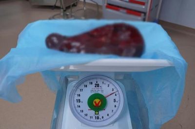 Bụng người đàn ông 69 tuổi ngày càng phình to, bác sĩ sững sờ khi phát hiện thứ 'khổng lồ' bên trong
