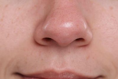 Mụn đầu đen tái đi tái lại dù chăm da kỹ? Nguyên nhân có thể nằm ở những thói quen hằng ngày của bạn