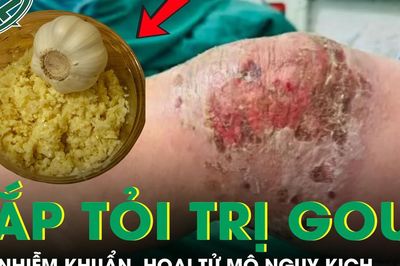 Người đàn ông sốc nhiễm khuẩn, hoại tử mô vì đắp tỏi trị gout