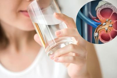 Ăn uống thế nào để giảm nguy cơ sỏi thận? 4 nguyên tắc càng biết sớm càng tốt