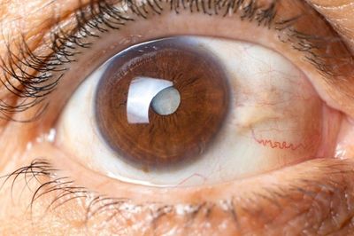 Phát hiện mới: Vitamin B3 giảm 66% nguy cơ mắc glôcôm ở người tăng nhãn áp?