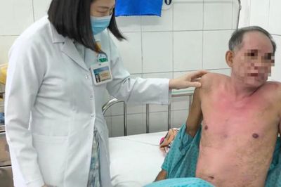 Dị ứng thuốc nhỏ mắt, người đàn ông bị hoại tử thượng bì nhiễm độc nguy kịch