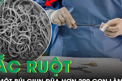 Bé gái 9 tuổi bị tắc ruột do một búi giun đũa hơn 200 con làm tổ