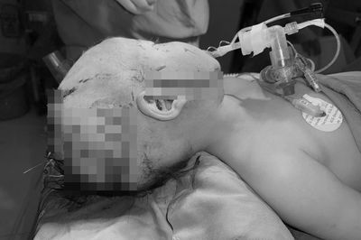 Bé trai 2 tuổi bị chó cắn, 2 chiếc răng cửa lọt sâu vào hốc mắt