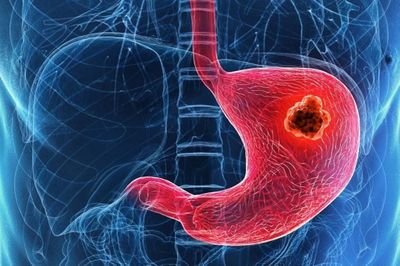 17 tuổi bị ung thư dạ dày, không qua khỏi sau 1,5 tháng phát hiện