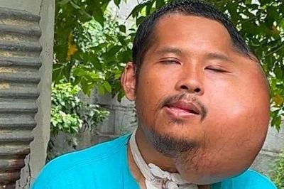 Xỉa răng sai cách, người đàn ông 31 tuổi có khuôn mặt 'đáng sợ'