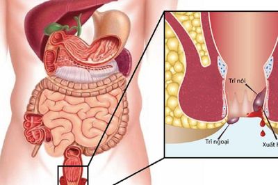 6 sai lầm khiến nhiều người điều trị trĩ thất bại