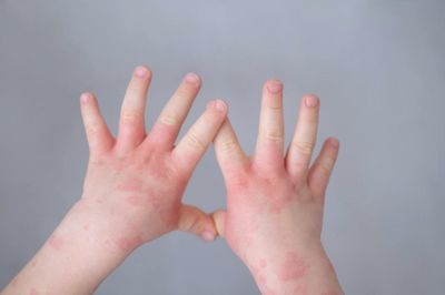 Cần làm gì khi trẻ dị ứng đạm sữa bò?