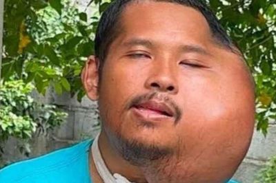 Người đàn ông có khuôn mặt biến dạng đến khó tin chỉ vì một thói quen mà nhiều người vẫn làm mỗi ngày