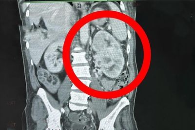 Trước cả đồ ăn, đây mới là thứ tàn phá thận của bạn âm thầm