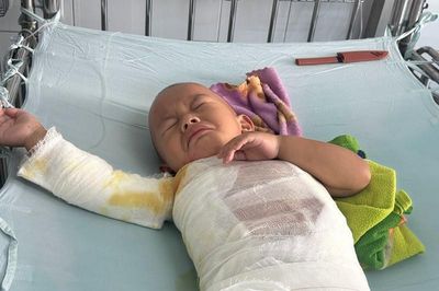 Mong cộng đồng giúp đỡ bé trai vùng cao ngã vào nồi nước sôi bị bỏng nặng